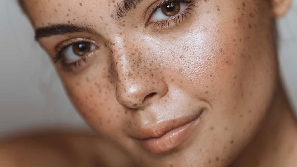 Óleo de bebê tem efeito para remover manchas e melasmas da pele de forma simples.